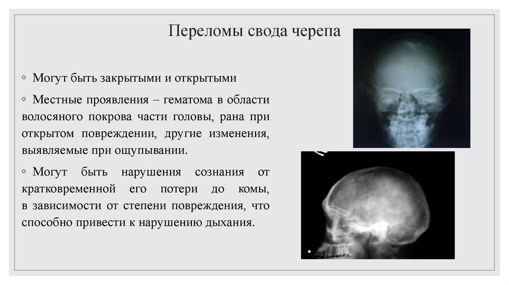 Переломы свода черепа