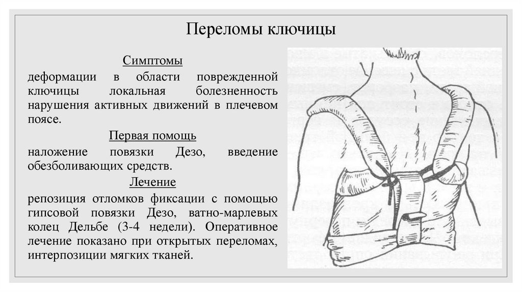 Переломы ключицы