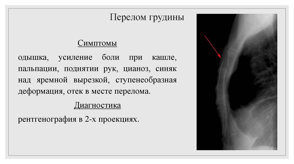 Перелом грудины