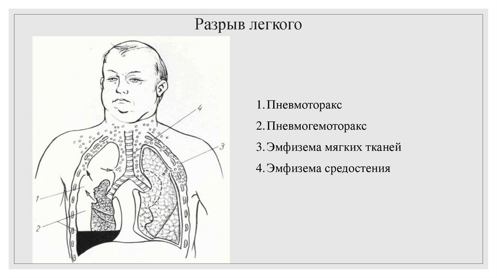 Разрыв легкого