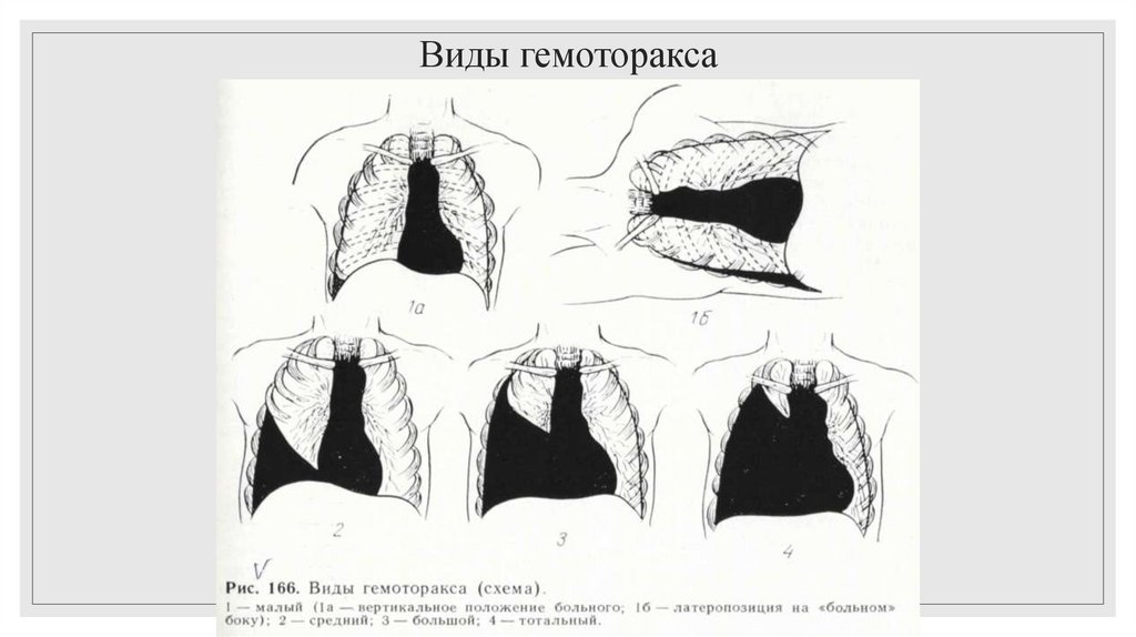 Виды гемоторакса