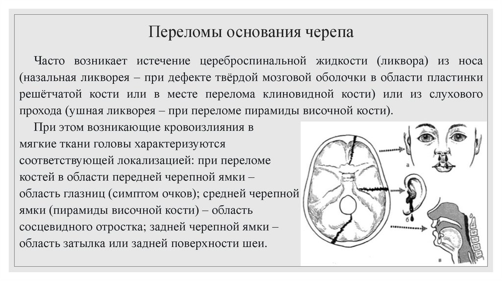 Переломы основания черепа