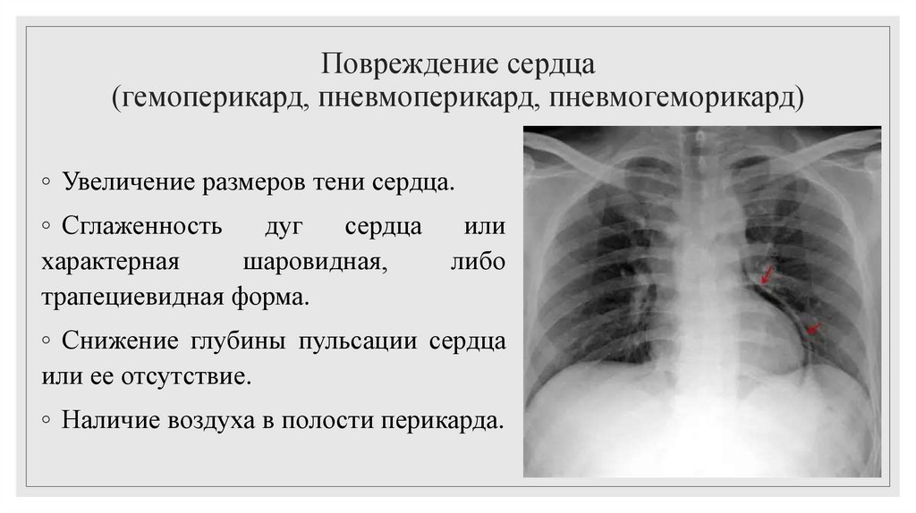 Повреждение сердца (гемоперикард, пневмоперикард, пневмогеморикард)
