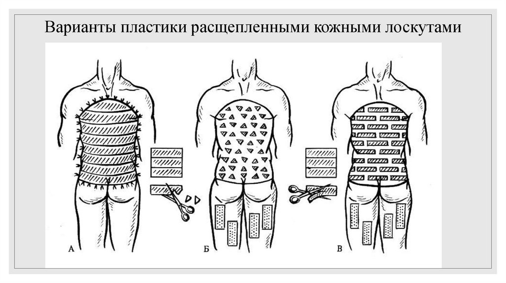 Варианты пластики расщепленными кожными лоскутами