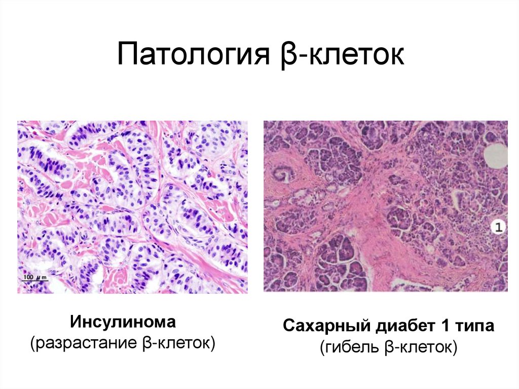 Патология β-клеток