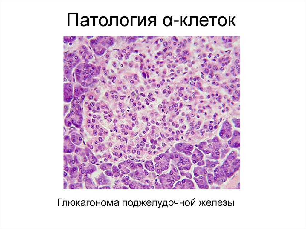 Патология α-клеток