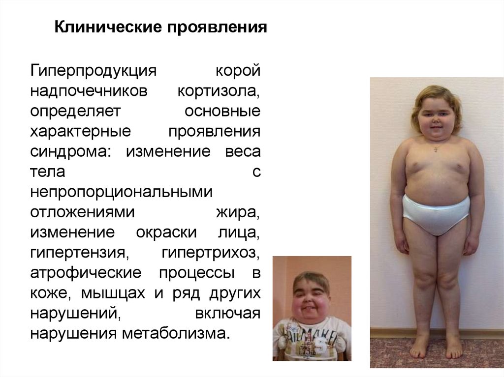 Патология коркового вещества надпочечников