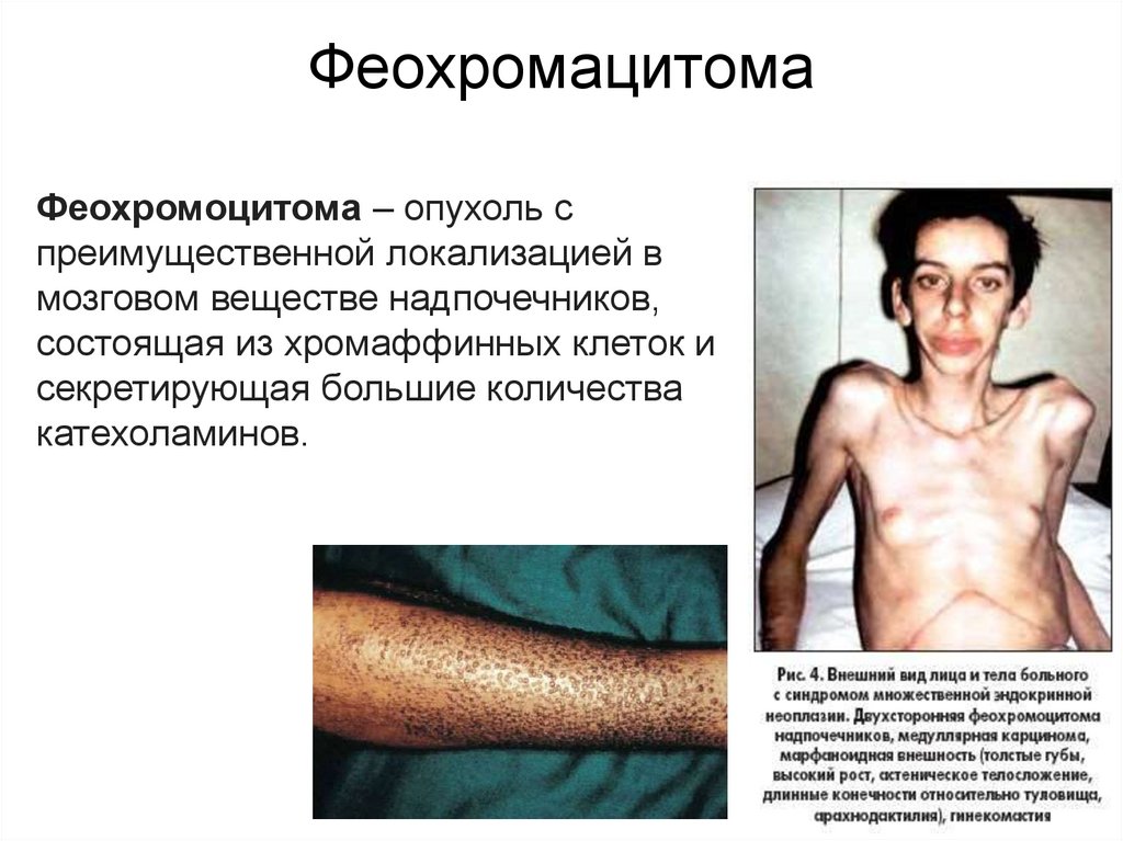 Патология хромаффинных клеток