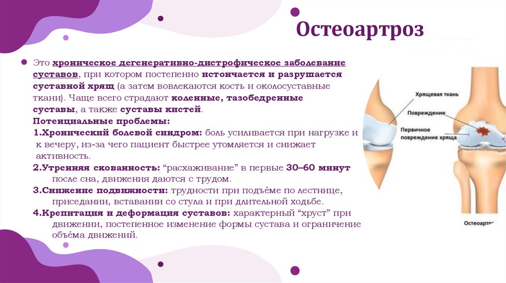 Остеоартроз