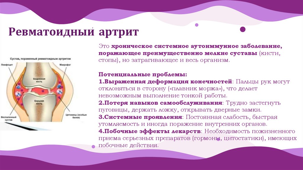 Ревматоидный артрит