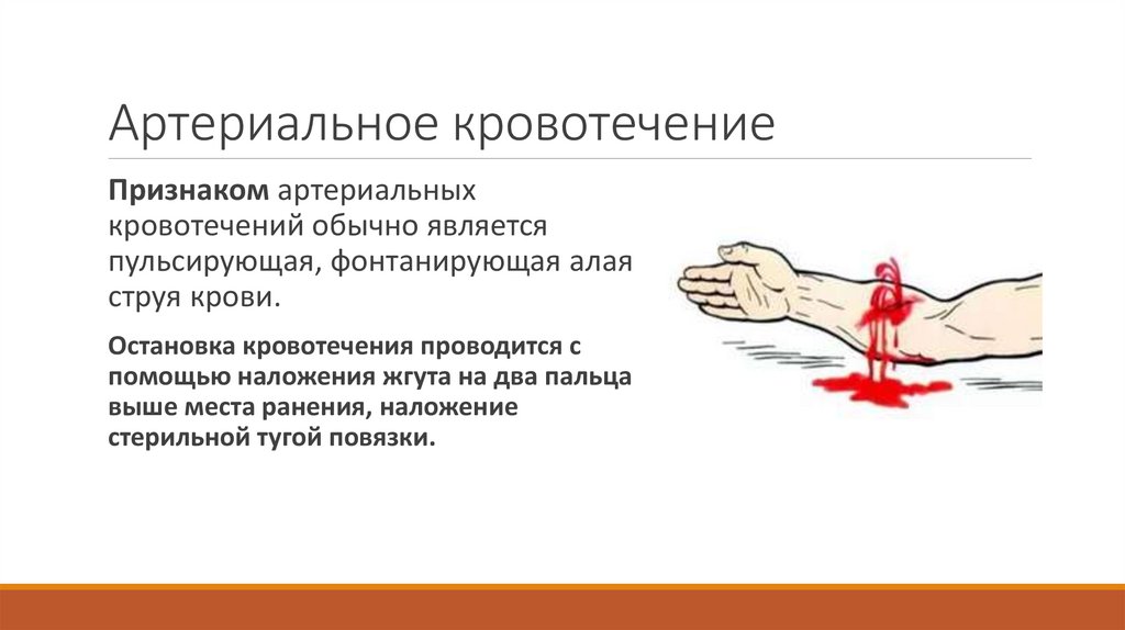 Артериальное кровотечение