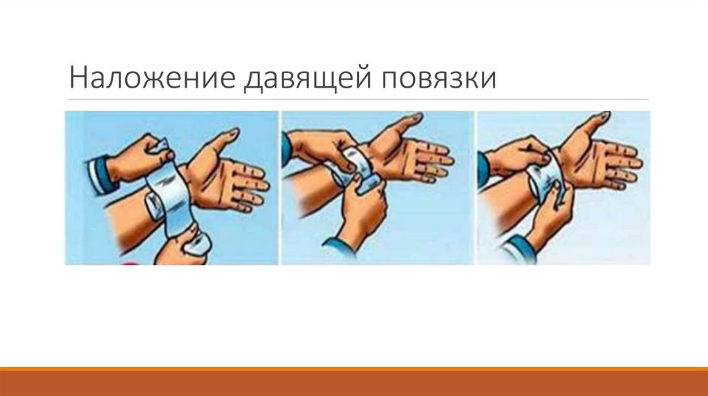 Наложение давящей повязки