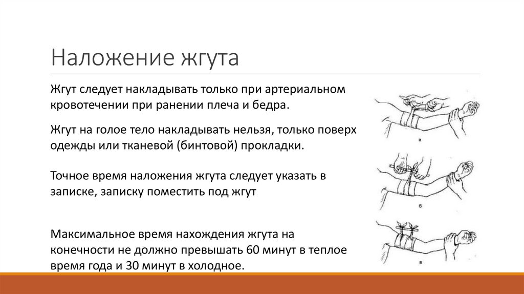 Наложение жгута