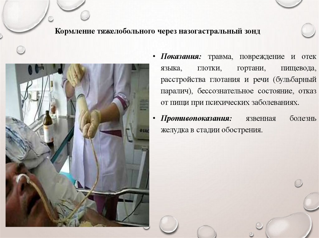 Кормление тяжелобольного через назогастральный зонд