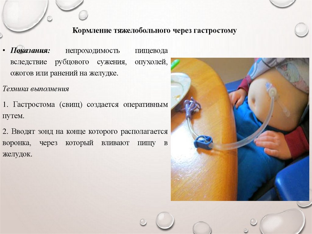 Кормление тяжелобольного через гастростому