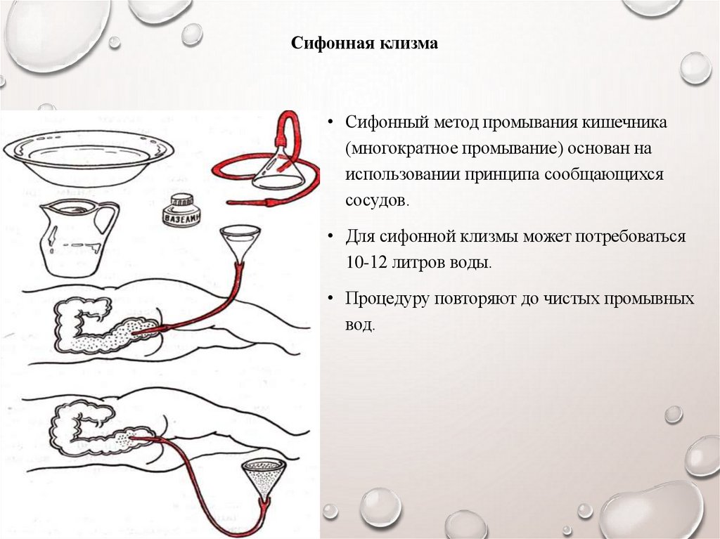 Сифонная клизма