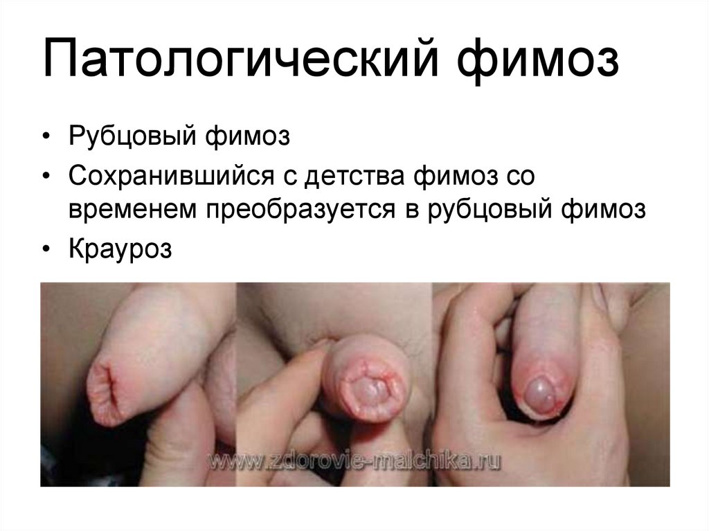 Патологический фимоз