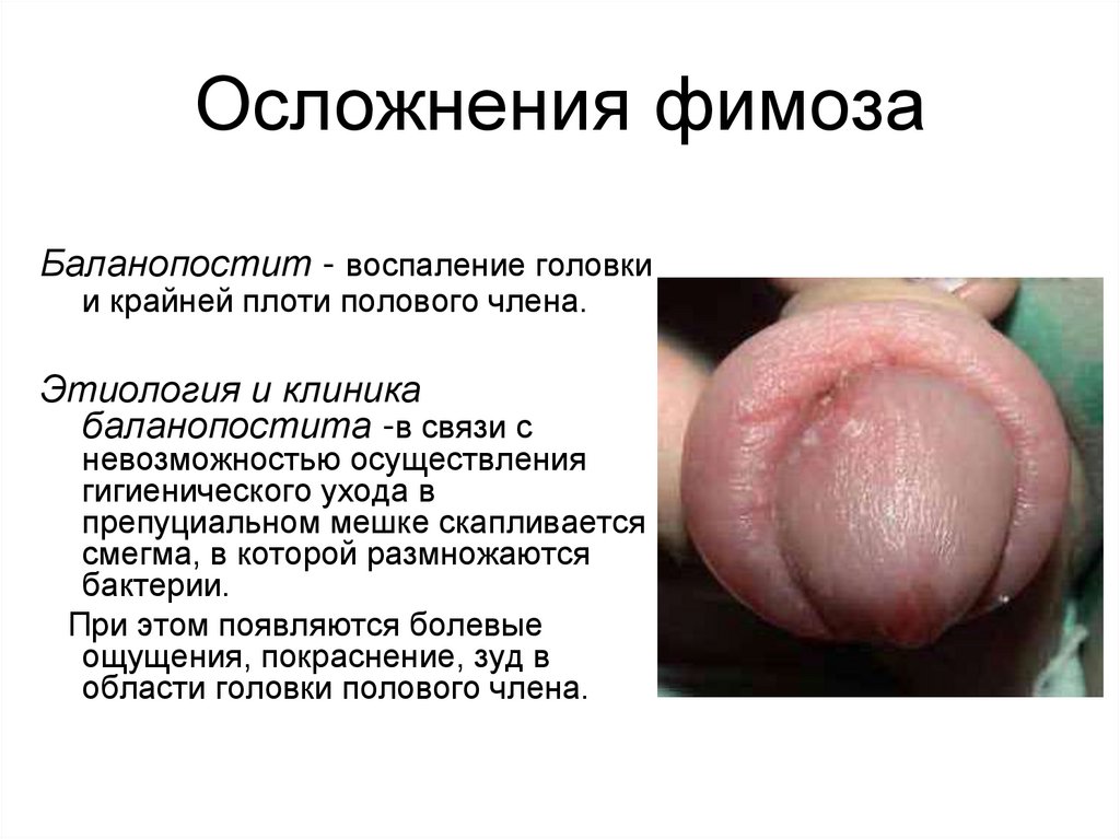 Осложнения фимоза