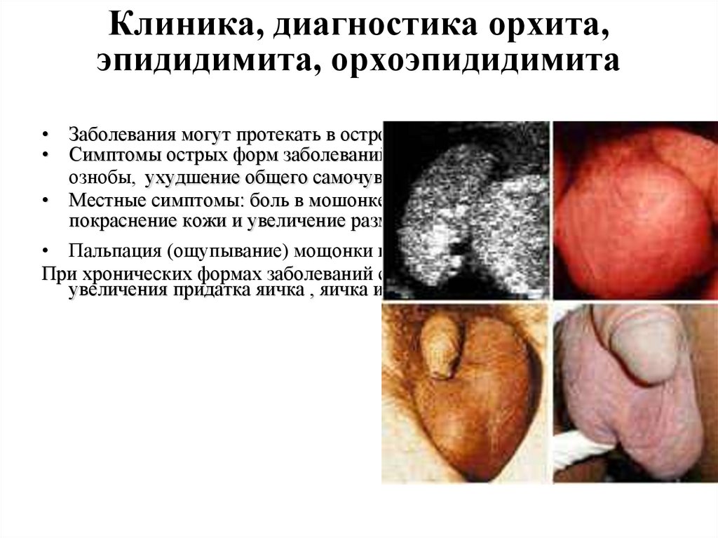 Клиника, диагностика орхита, эпидидимита, орхоэпидидимита