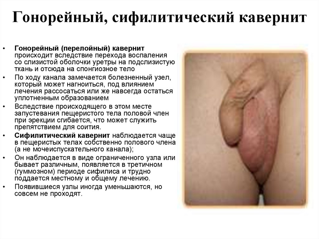 Гонорейный, сифилитический кавернит