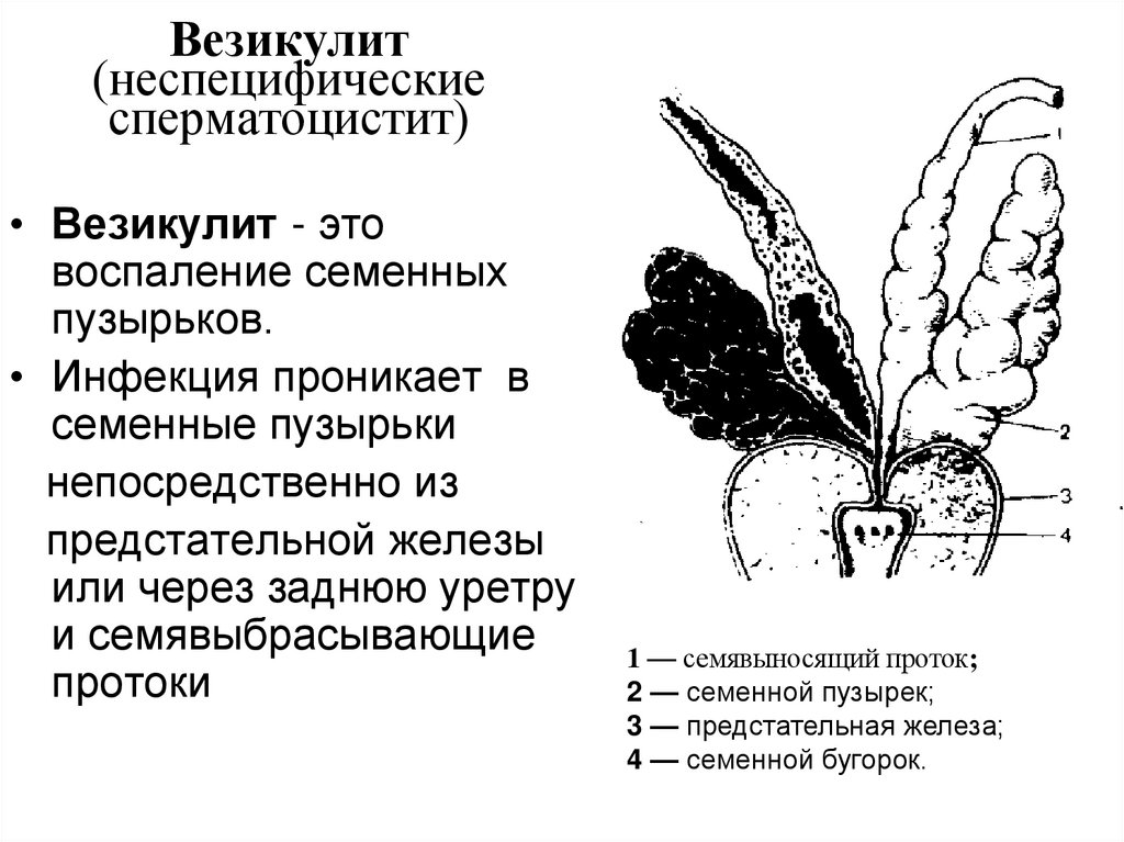 Везикулит (неспецифические сперматоцистит)