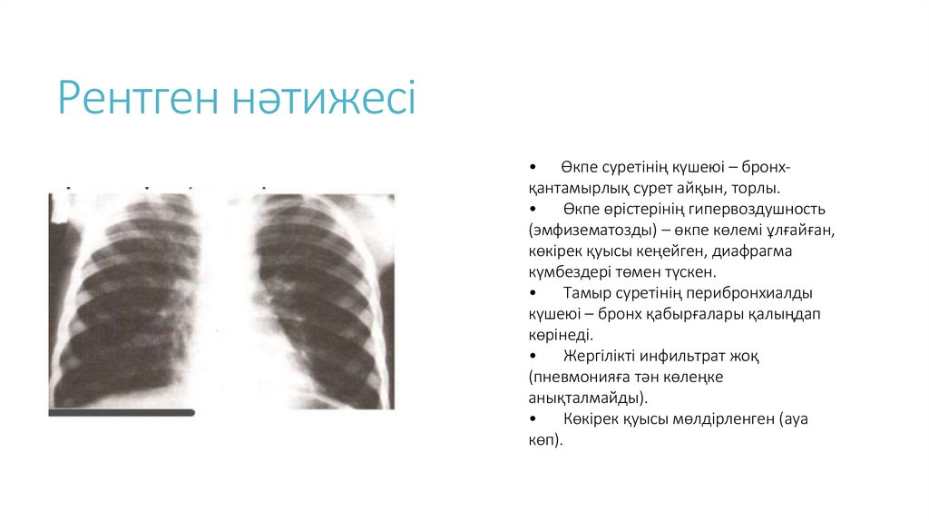 Рентген нәтижесі