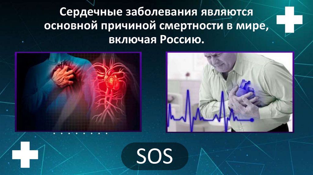 Сердечные заболевания являются основной причиной смертности в мире, включая Россию.