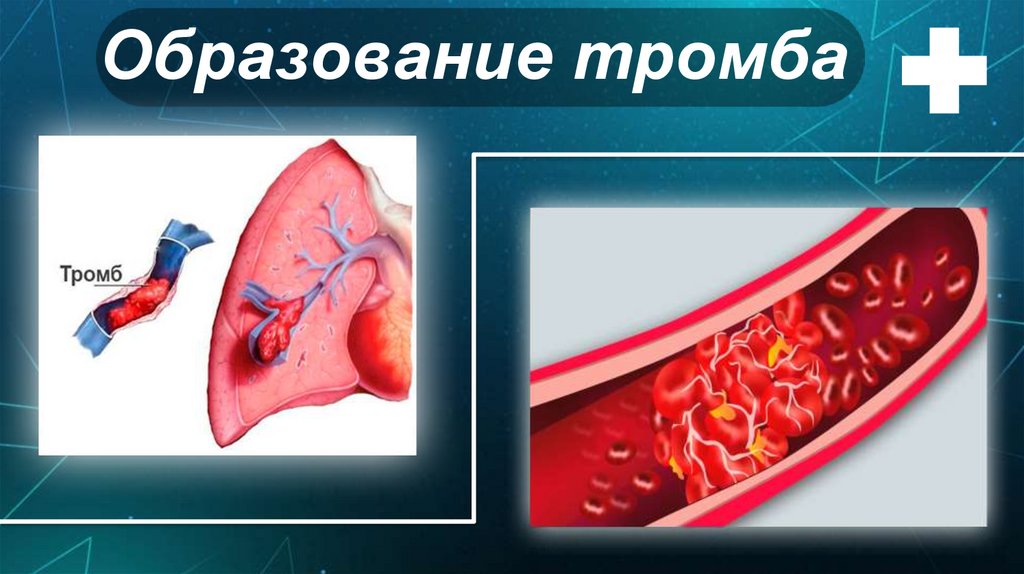 Образование тромба