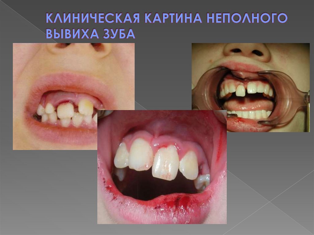 КЛИНИЧЕСКАЯ КАРТИНА НЕПОЛНОГО ВЫВИХА ЗУБА