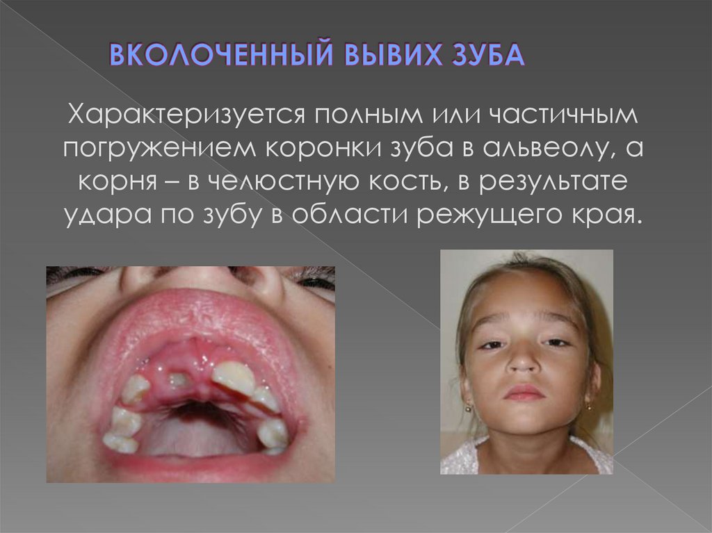 ВКОЛОЧЕННЫЙ ВЫВИХ ЗУБА