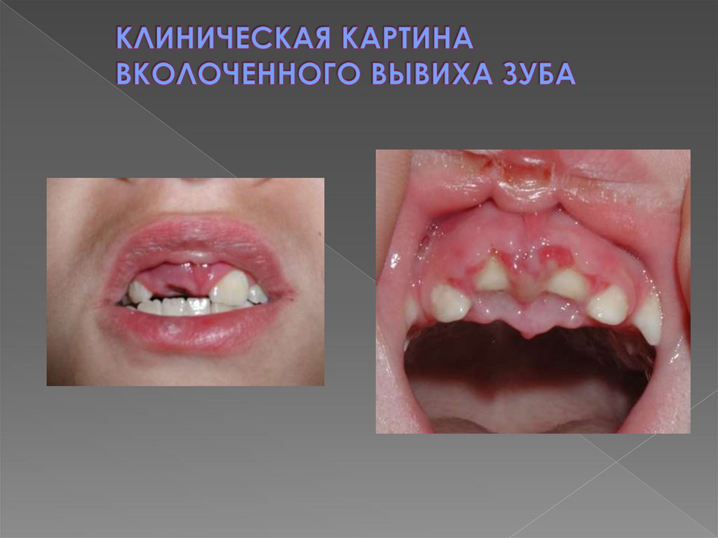 КЛИНИЧЕСКАЯ КАРТИНА ВКОЛОЧЕННОГО ВЫВИХА ЗУБА