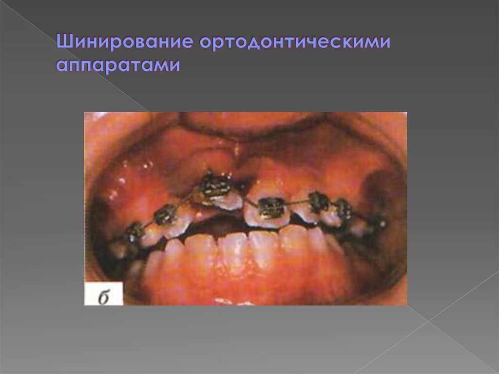 Шинирование ортодонтическими аппаратами