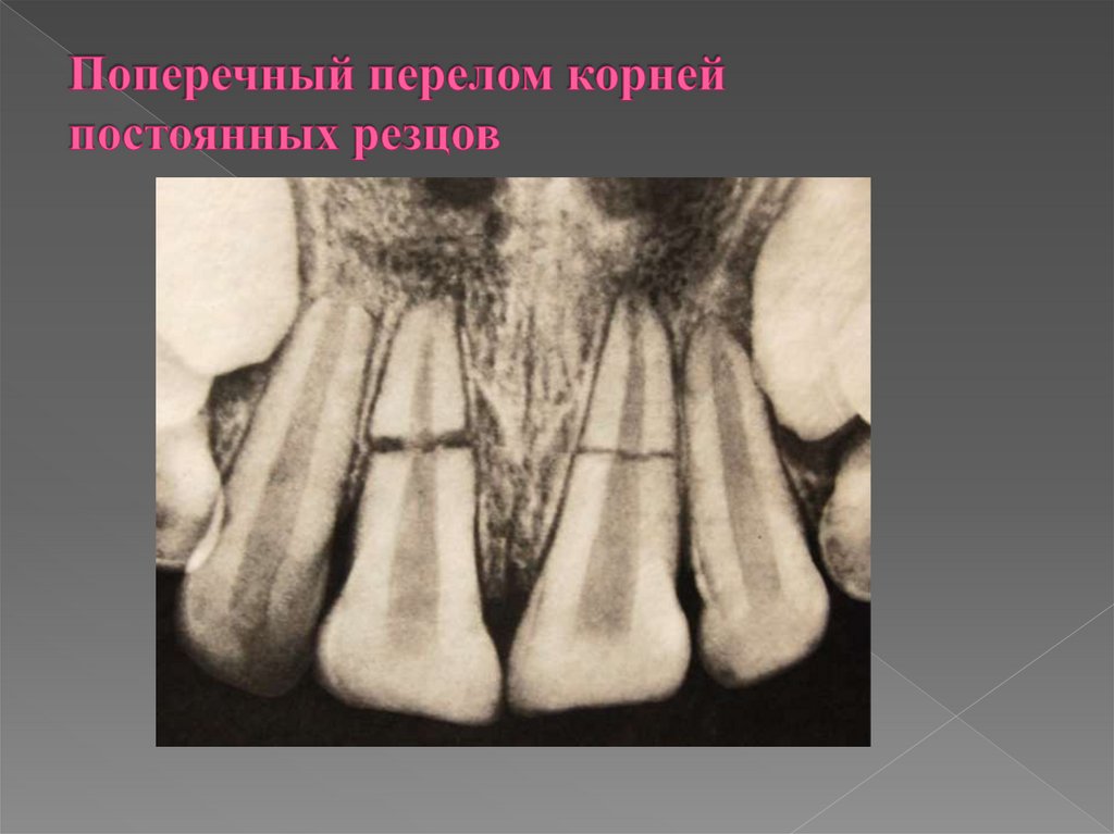 Поперечный перелом корней постоянных резцов