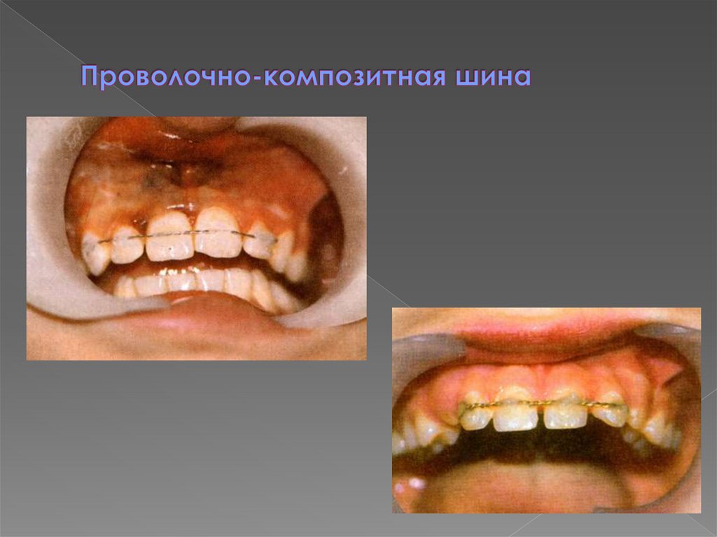 Проволочно-композитная шина