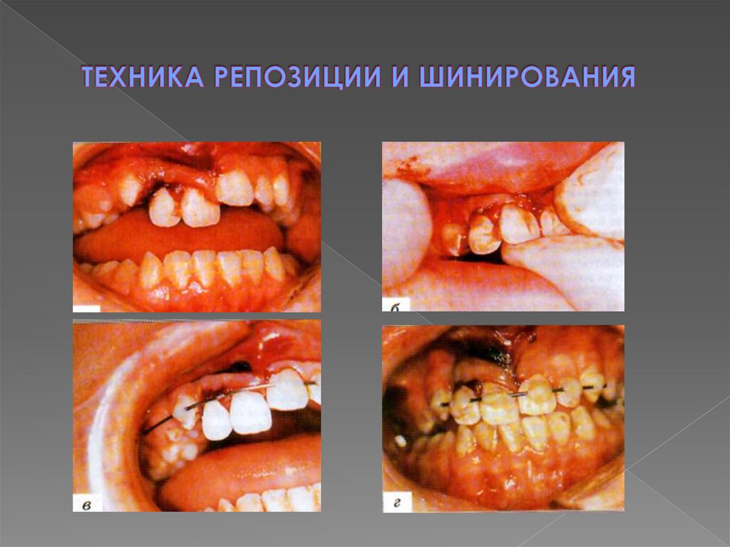 ТЕХНИКА РЕПОЗИЦИИ И ШИНИРОВАНИЯ
