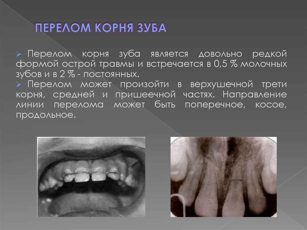 ПЕРЕЛОМ КОРНЯ ЗУБА