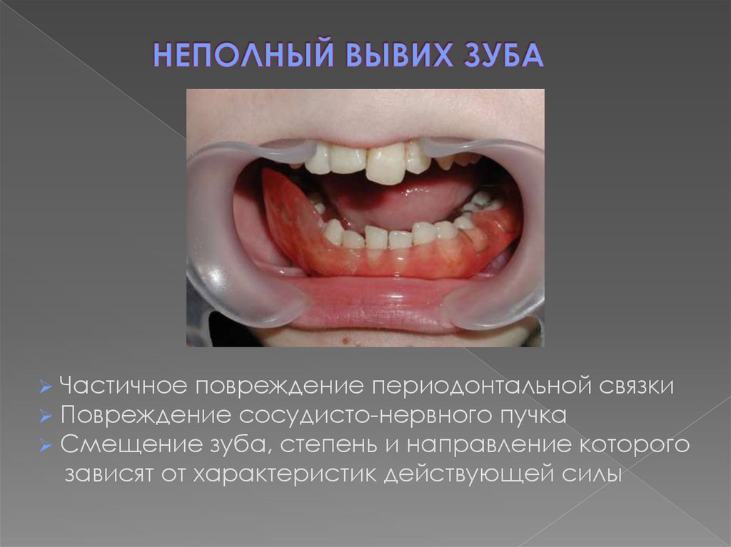 НЕПОЛНЫЙ ВЫВИХ ЗУБА