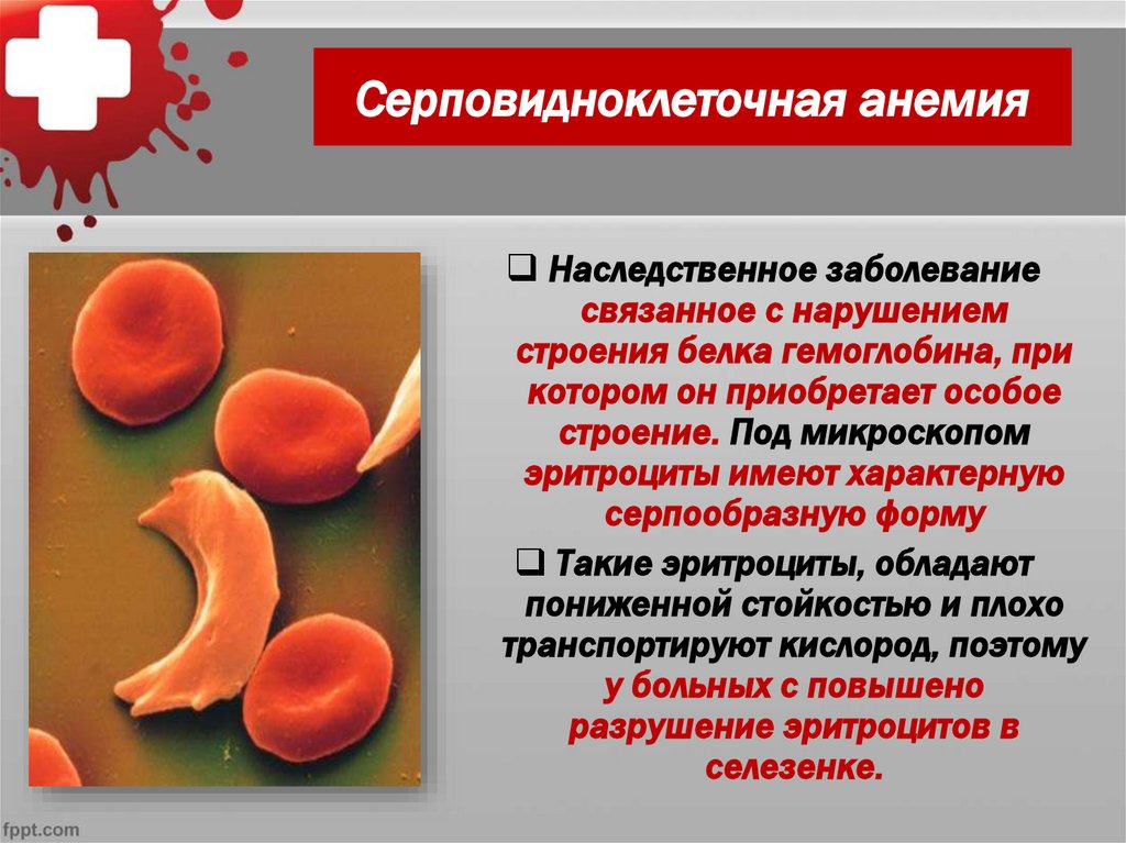 Серповидноклеточная анемия