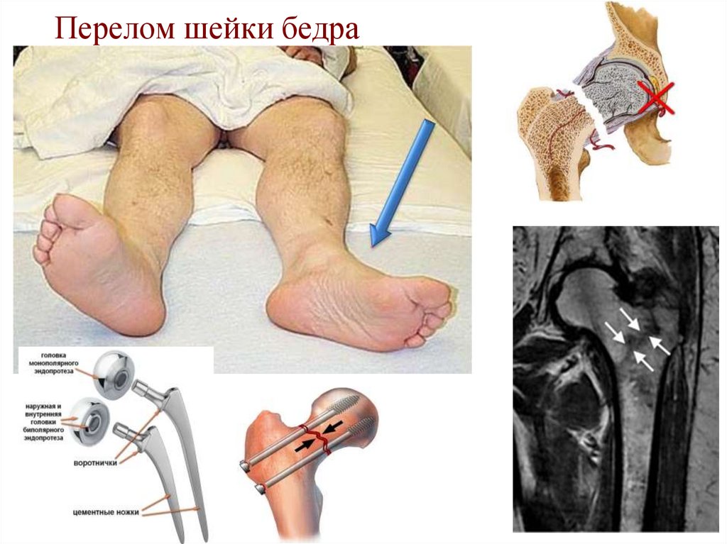 Перелом шейки бедра