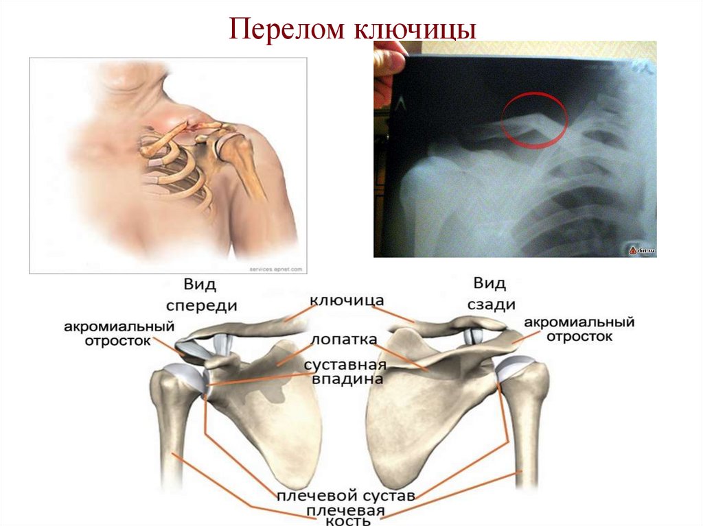 Перелом ключицы