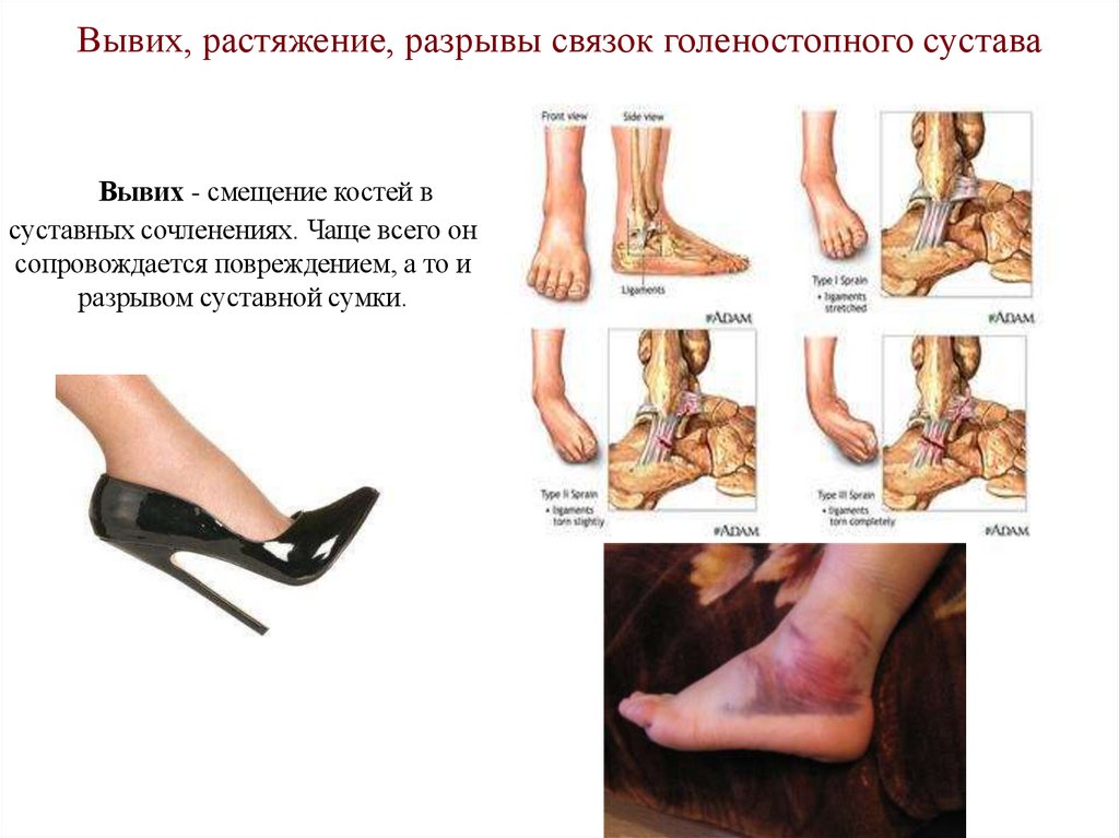 Вывих, растяжение, разрывы связок голеностопного сустава