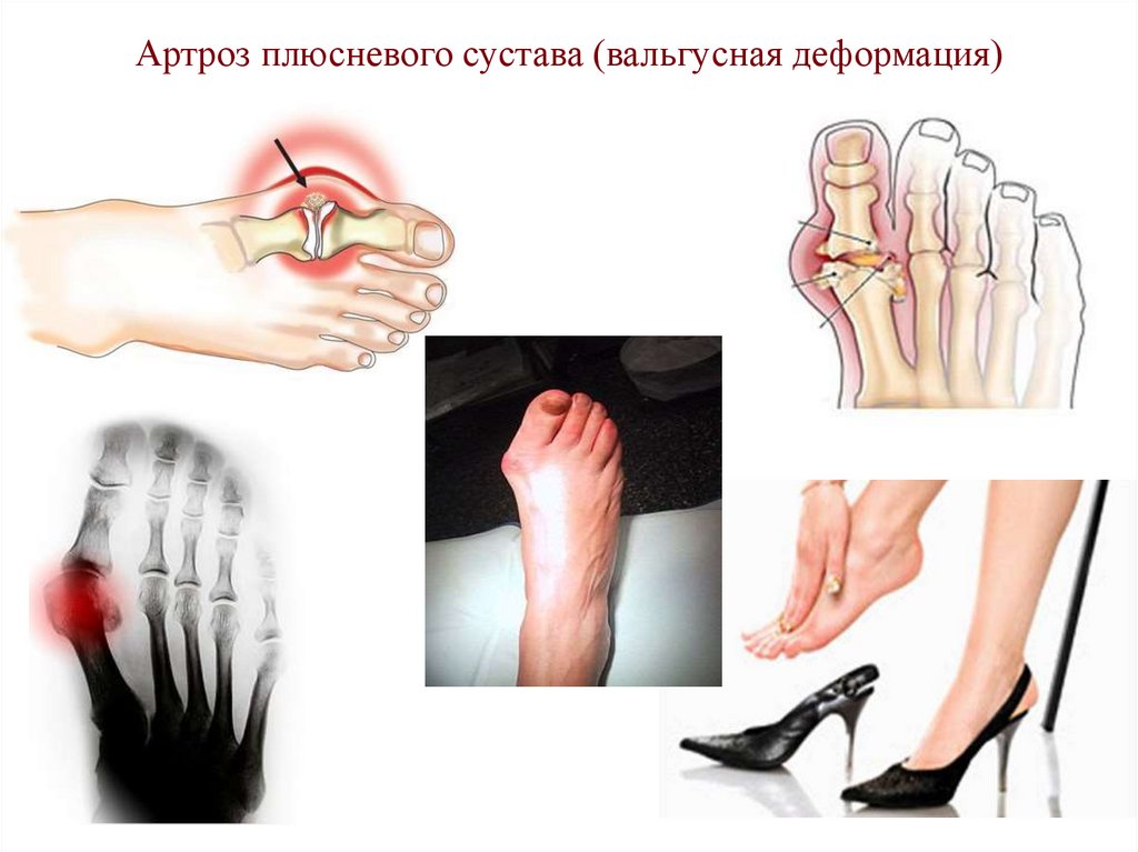 Артроз плюсневого сустава (вальгусная деформация)