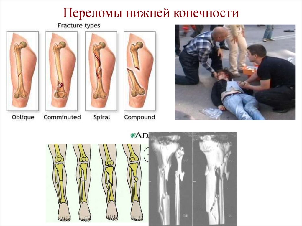 Переломы нижней конечности