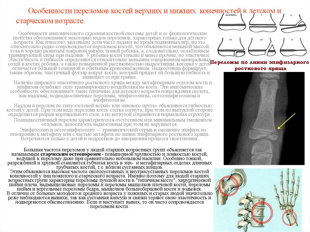 Особенности переломов костей верхних и нижних конечностей в детском и старческом возрасте.