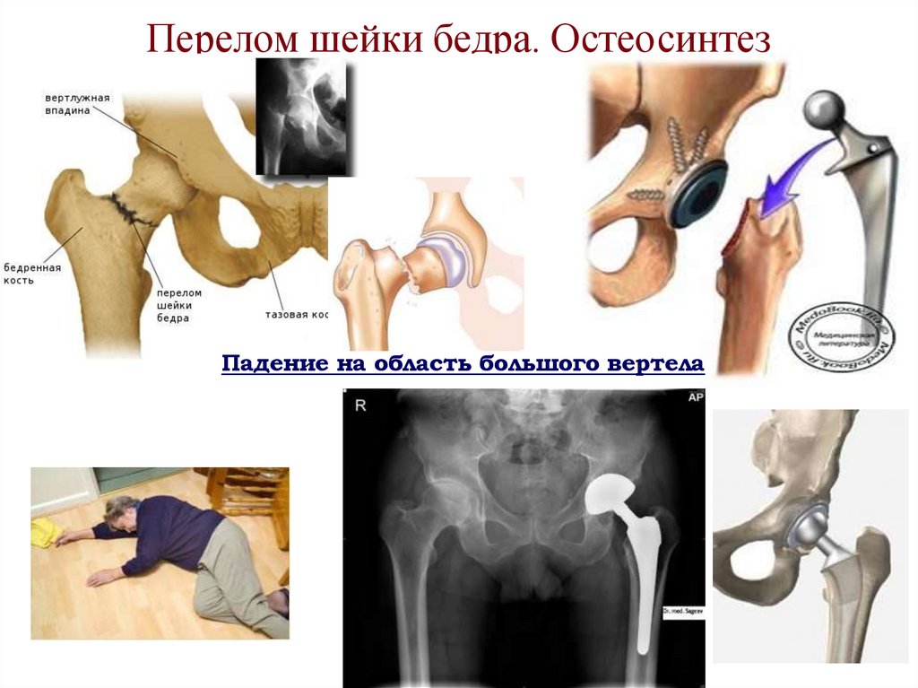 Перелом шейки бедра. Остеосинтез