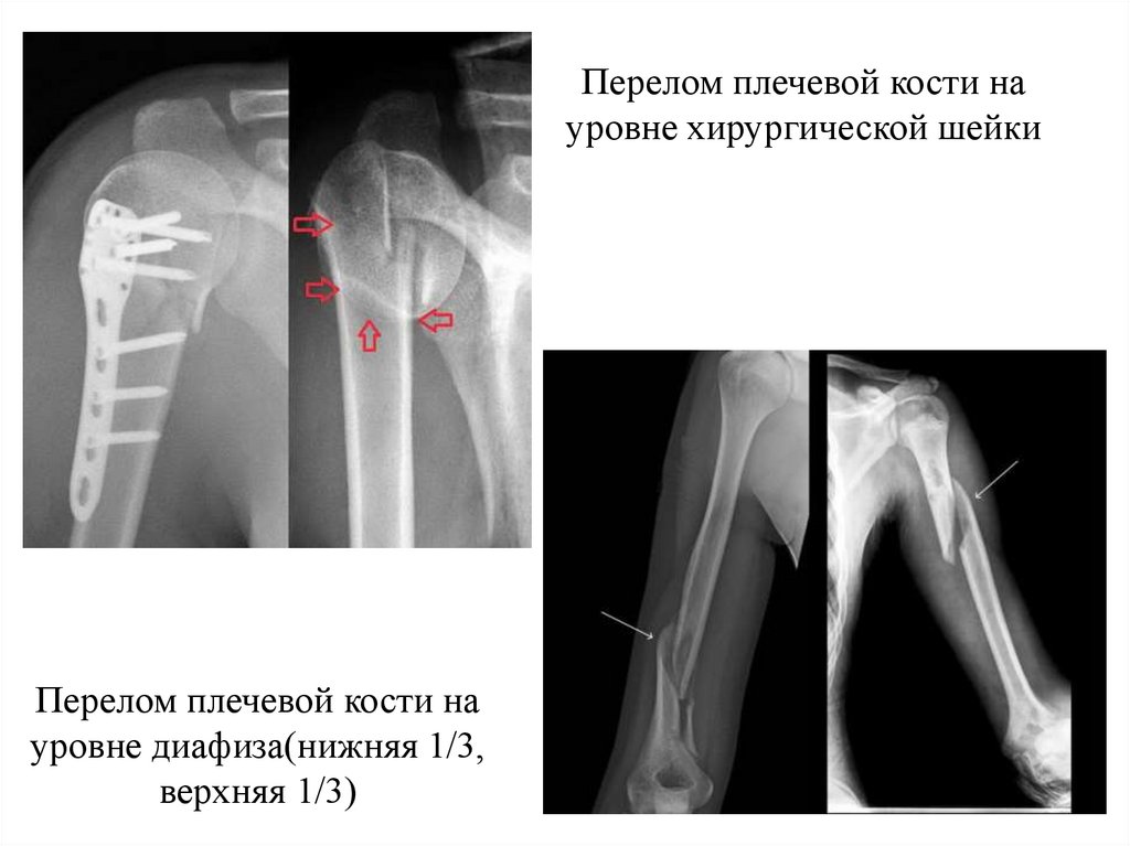 Перелом плечевой кости на уровне хирургической шейки