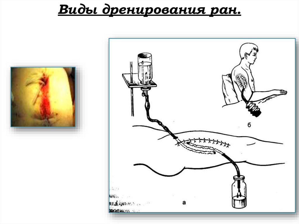 Виды дренирования ран.
