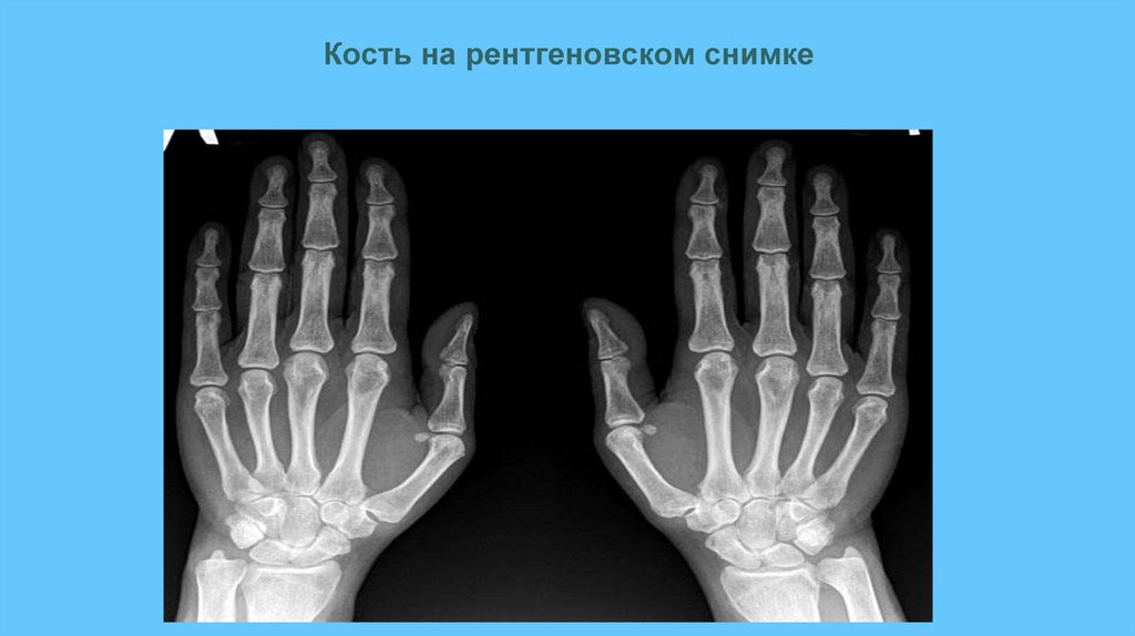 Кость на рентгеновском снимке