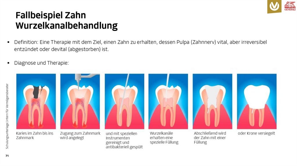 Fallbeispiel Zahn Wurzelkanalbehandlung