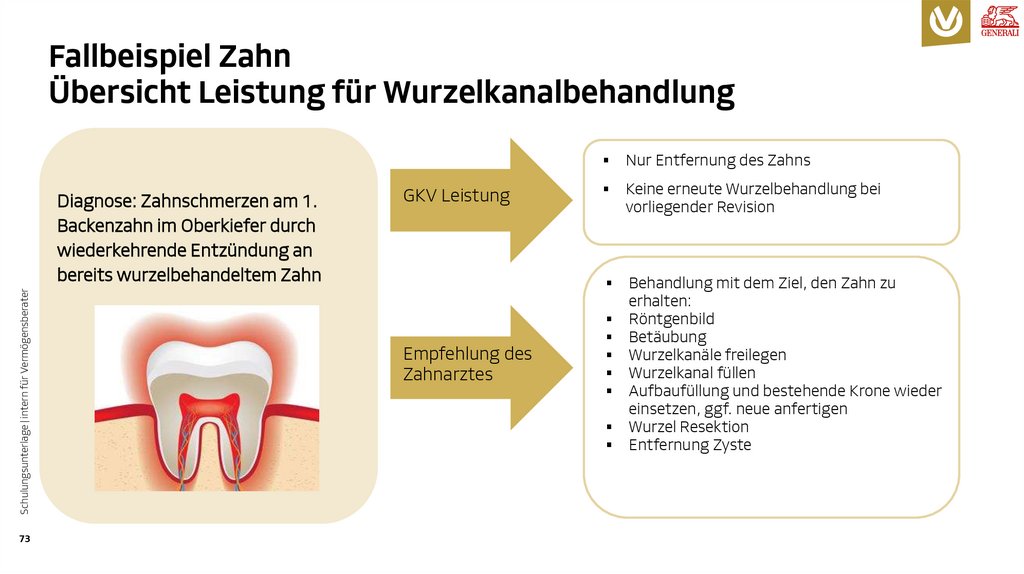 Fallbeispiel Zahn Übersicht Leistung für Wurzelkanalbehandlung